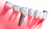 Высококачественная установка надежных зубных имплантов с гарантией